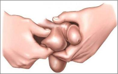 Hạch ở tinh hoàn- Cảnh báo bệnh lý nguy hiểm! 