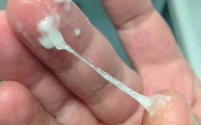 Khí hư đặc quánh như keo là dấu hiệu của bệnh gì?
