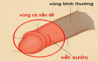 Buốt dương vật là bị làm sao?
