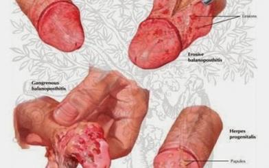 Đầu dương vật bị đỏ là bệnh gì? Chữa trị như thế nào?
