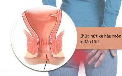 Chữa nứt kẽ hậu môn ở đâu tốt nhất?