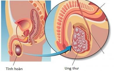Cơ hội mới cho bệnh nhân ung thư tinh hoàn