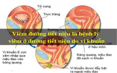 Viêm đường tiết niệu: Triệu chứng và cách chữa hiệu quả nhất
