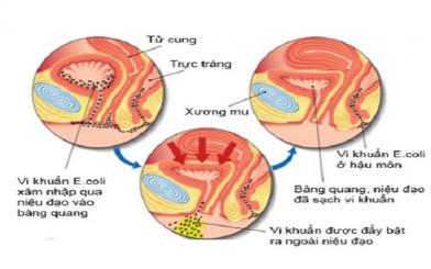 Viêm đường tiết niệu nữ: đối tượng và những biến chứng nguy hiểm!