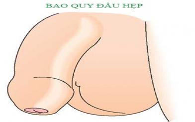 Hẹp bao quy đầu có nguy hiểm không?
