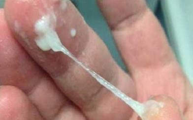 Bác sĩ chia sẻ cách chữa khí hư màu trắng đục an toàn hiệu quả số 1