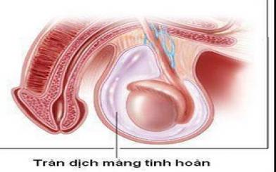 Tràn dịch màng tinh hoàn có nguy hiểm không nam giới hãy cẩn trọng!
