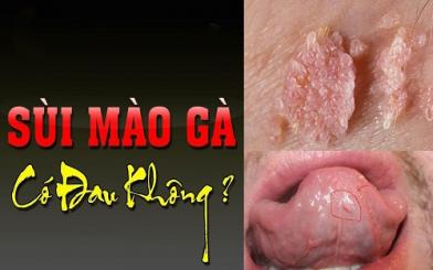 Sùi mào gà có đau không cách nhận biết và chữa trị bệnh hiệu quả