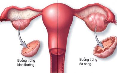 Buồng trứng đa nang là gì? Cách điều trị tại nhà hiệu quả nhất