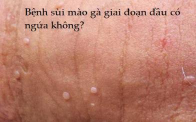 [Tìm hiểu trước khi quá muộn] Sùi mào gà giai đoạn đầu có ngứa không? 