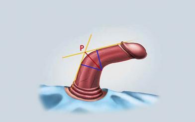 Dương vật cong do đâu? Mức độ nguy hiểm và xử lý thế nào?