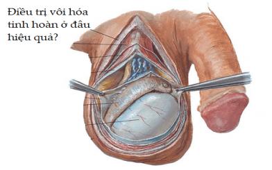Điều trị vôi hóa tinh hoàn ra sao? [Top 5 địa chỉ chữa uy tín]