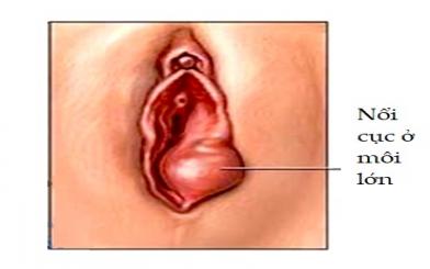 Ngứa và nổi cục ở môi lớn có phải ung thư?