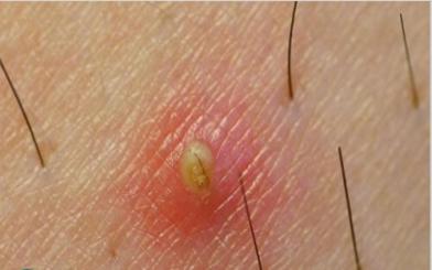 Nổi mụn ở tinh hoàn một cách bất thường – Coi chừng trọng bệnh!