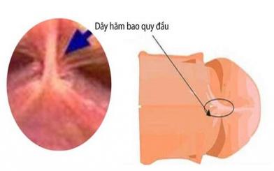 Có phải cắt dây hãm bao quy đầu không? Bao nhiêu tiều?