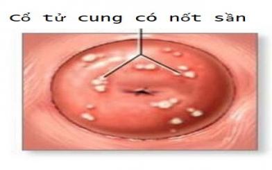 Cổ tử cung có nốt sần là bệnh gì [3 địa chỉ chữa an toàn]