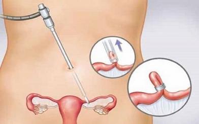 Phương pháp thông tắc vòi trứng là gì? [Tìm hiểu A-Z]