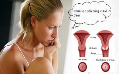 Chữa lộ tuyến bằng RFA ở đâu? [4 địa chỉ nổi tiếng Hà Nội]