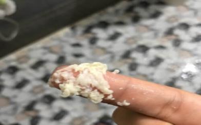 Khí hư giống bã đậu: Khi nào cần đi khám bác sĩ?