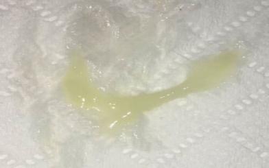 Khí hư đặc màu vàng xanh dấu hiệu bệnh gì? Chữa trị thế nào?