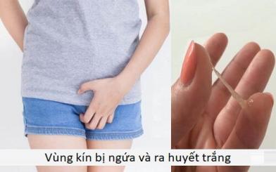 Vùng kín bị ngứa và ra huyết trắng cảnh báo viêm lộ tuyến cổ tử cung