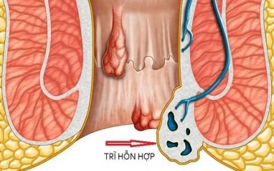 Tổng hợp tất cả kiến thức về trĩ hỗn hợp