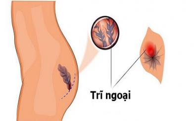 Cách chữa trĩ ngoại hiệu quả, an toàn, nhiều người dùng