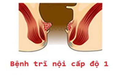 Tổng hợp tất cả thông tin về bệnh trĩ nội cấp độ 1