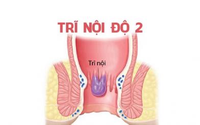 Trĩ nội độ 2 có chữa được không? Trị tại nhà có tốt?