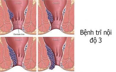 Điều trị trĩ nội độ 3 tại nhà có triệt tiêu được búi trĩ?