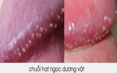 Cách điều trị chuỗi hạt ngọc dương vật bằng thuốc có tốt?