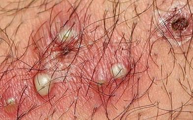 Mọc mụn ở vùng kín nữ là bệnh gì? Cách điều trị tích cực