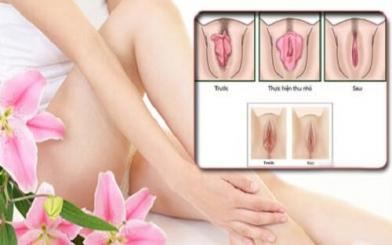 Kiến thức tổng hợp về thu nhỏ vùng kín [Chị em nên biết] 