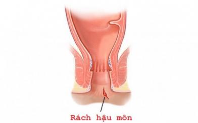 Rách hậu môn: Nguyên nhân, triệu chứng, cách điều trị