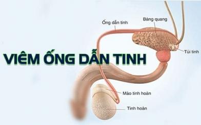 Viêm ống dẫn tinh ở nam giới [Tổng hợp kiến thức]