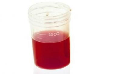 Nước đái đỏ ở nam và nữ là bệnh gì? Điều trị thế nào?