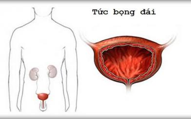 Tức bọng đái: Nguyên nhân, triệu chứng, cách chữa trị