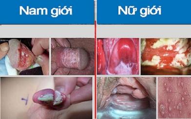 Viêm vùng kín ở nam, nữ giới [Kiến thức tổng hợp từ A- Z] 