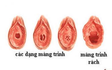 Rách màng trinh [Tổng hợp thông tin chi tiết cho nữ giới]