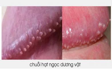 Chuỗi hạt ngọc dương vật [Tổng hợp kiến thức cho nam giới]