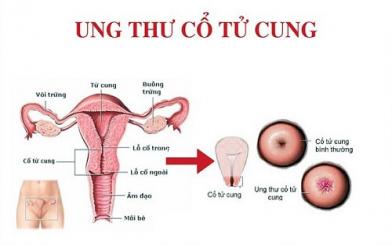 Ung thư cổ tử cung [Tất tần tật kiến thức nữ giới nên biết]