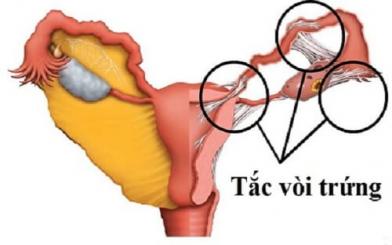 Tắc vòi trứng: Nguyên nhân, dấu hiệu, tác hại, cách chữa