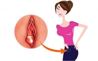 Sưng cô bé – Hiện tượng bất thường chớ chủ quan!