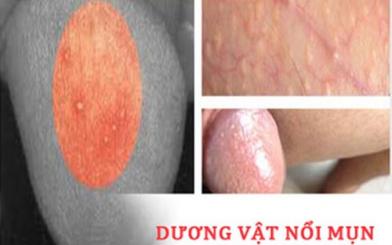 Bị mụn ở bao quy đầu [Kiến thức tổng quan]