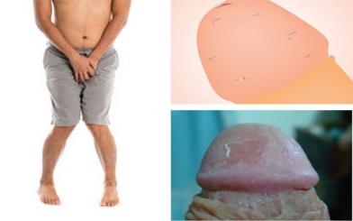 Bao quy đầu bị ngứa và bong da- Điều trị trước khi quá muộn
