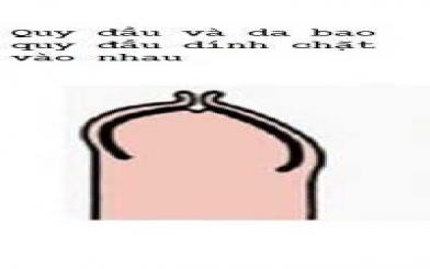 Bao quy đầu bị dính- Tìm hiểu cách xử lý hiệu quả!