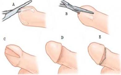 Cắt bao quy đầu để làm gì? Phương pháp cắt an toàn?
