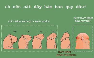 Có nên cắt dây hãm bao quy đầu? Cắt tại nhà được không?