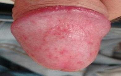 Viêm da quy đầu do đâu? [5 nguyên nhân điển hình]