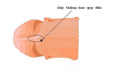 Dây thắng bao quy đầu là gì? Đứt dây thắng nguy hiểm không?
